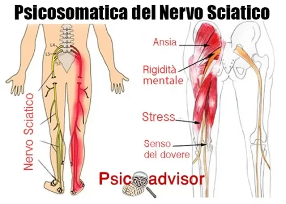 Nervo sciatico infiammato Nervo sciatico infiammato