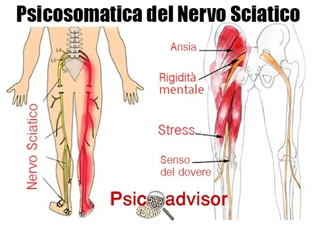 Nervo sciatico infiammato Nervo sciatico infiammato